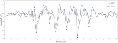 Dysfunction of the Auditory Brainstem as a Neurophysiology Subtype of Autism Spectrum Disorder